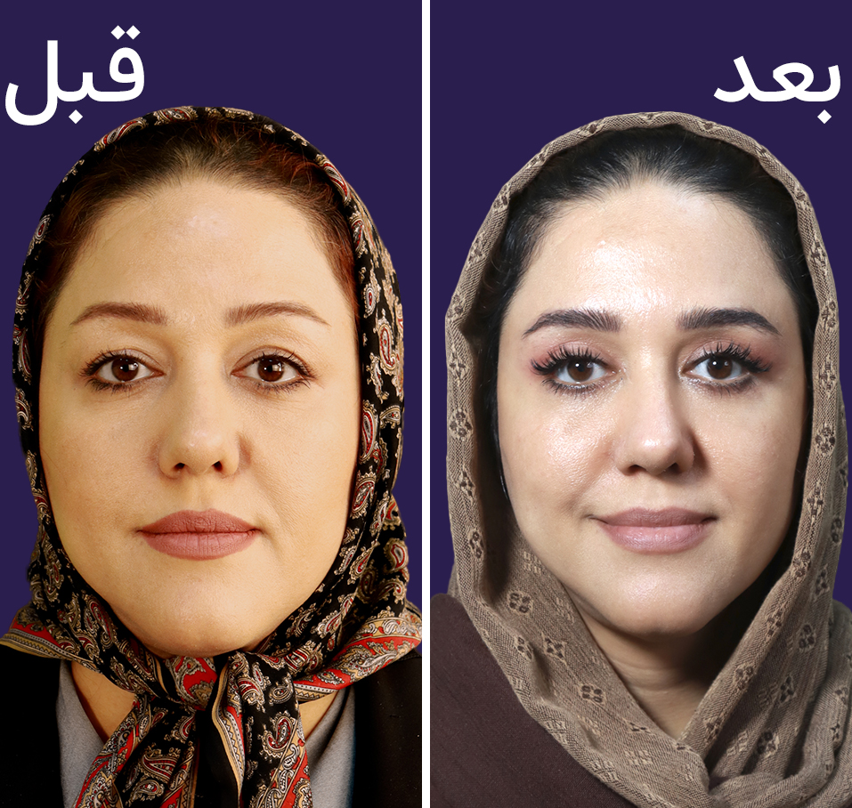 عکس بلفاروپلاستی