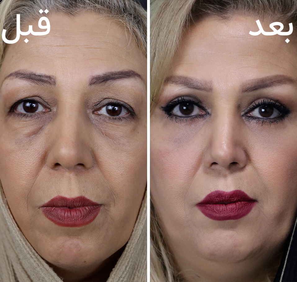 عکس قبل و بعد بلفارو