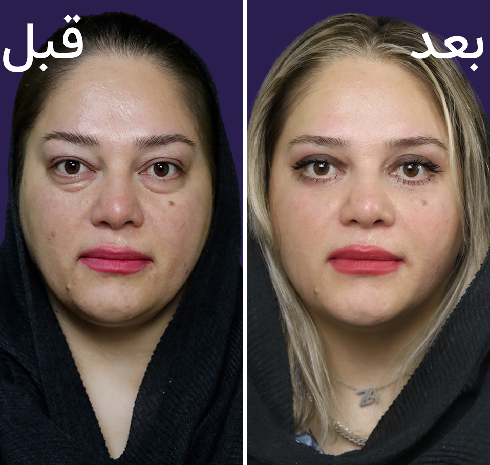 نمونه عمل بلفاروپلاستی