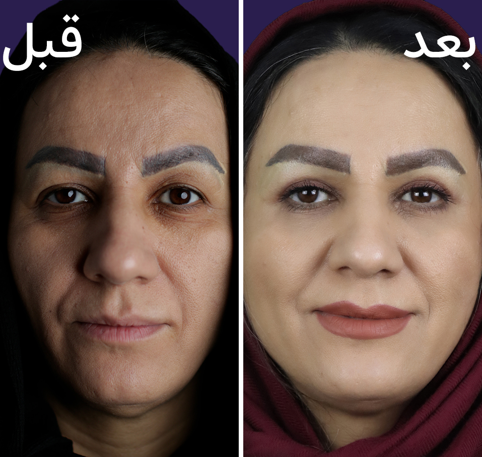 عکس قبل و بعد بلفاروپلاستی