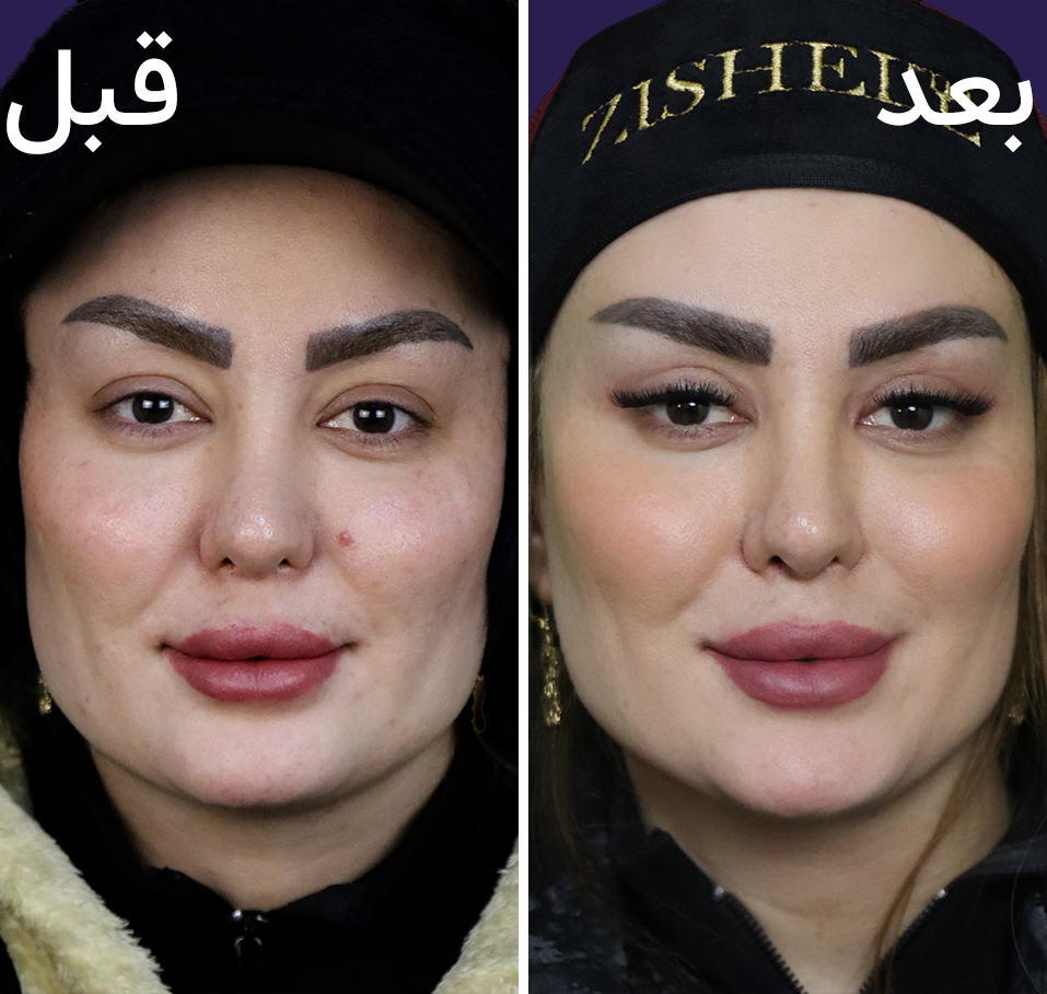 تصاویر قبل و بعد بلفا
