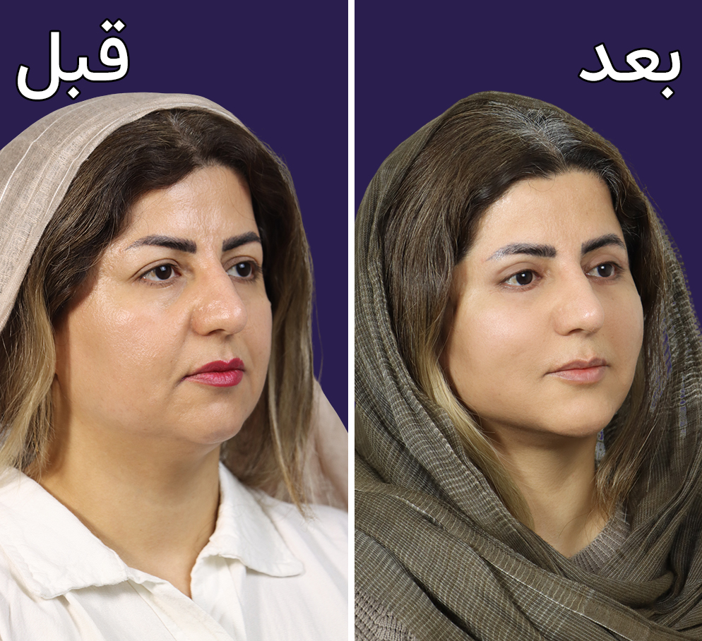 عکس قبل و بعد اندولیفت