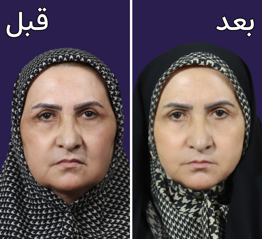 تصاویر قبل و بعد اندولیفت در مطب دکتر ساعدی