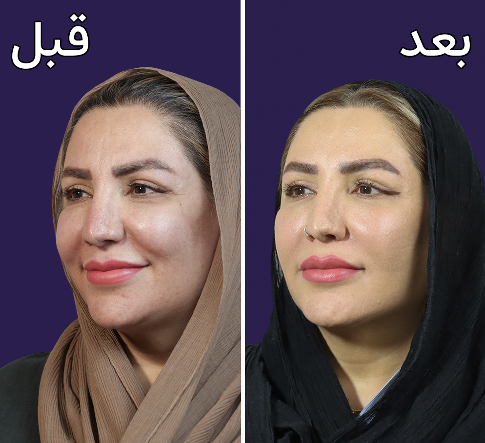 تصاویر قبل و بعد از اندولیفت در مجموعه دکتر ساعدی