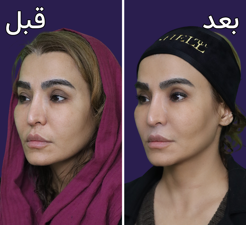 تصاویر قبل و بعد از اندولیفت در مجموعه دکتر سعید ساعدی