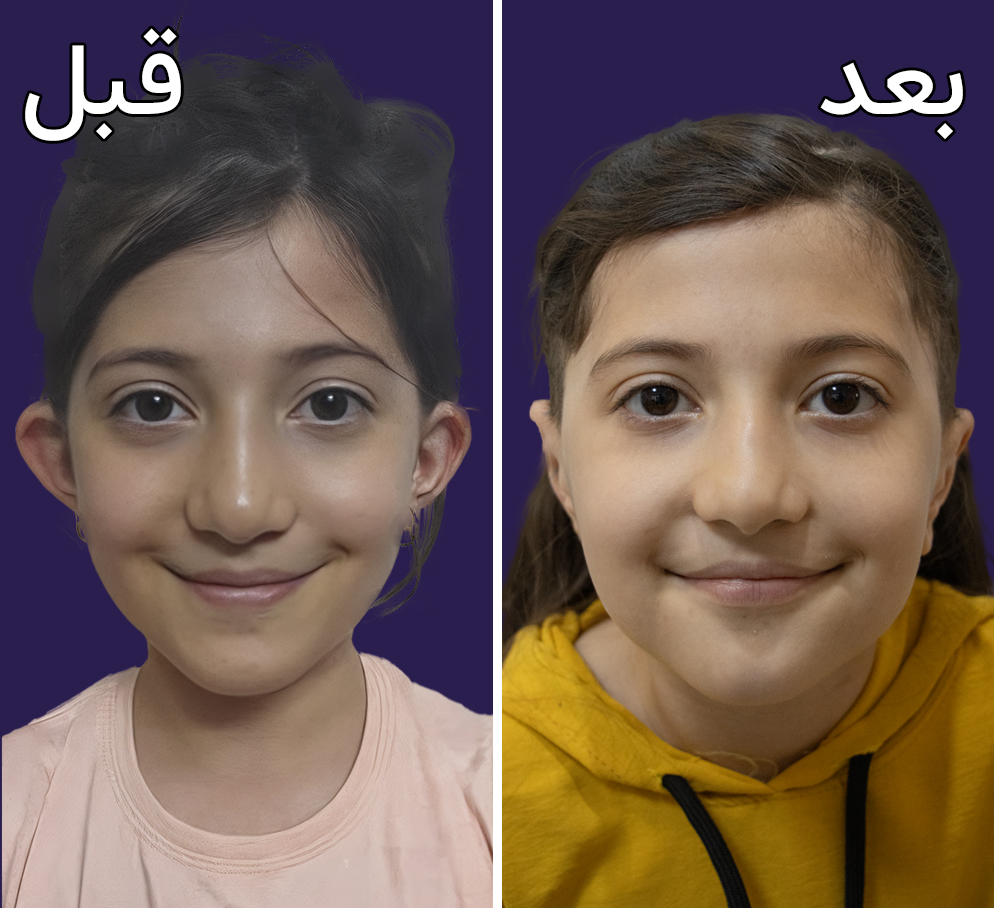 تصاویر قبل و بعد جراحی گوش