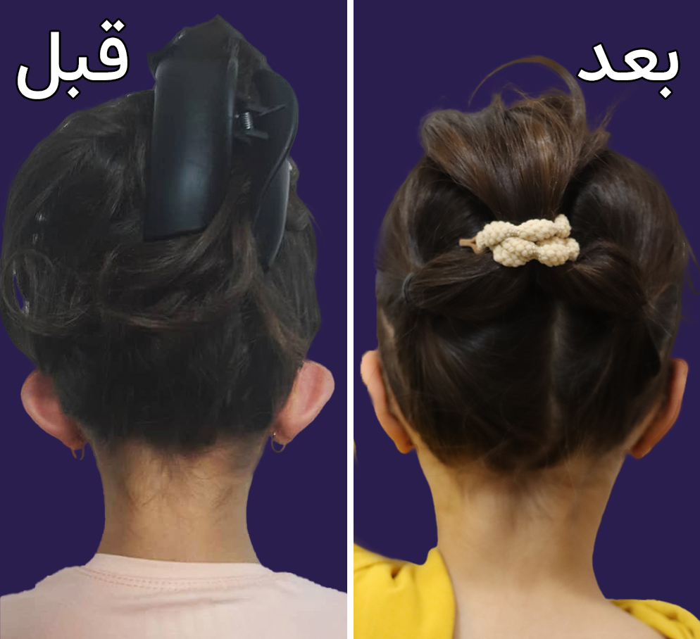 تصاویر قبل و بعد اتوپلاستی