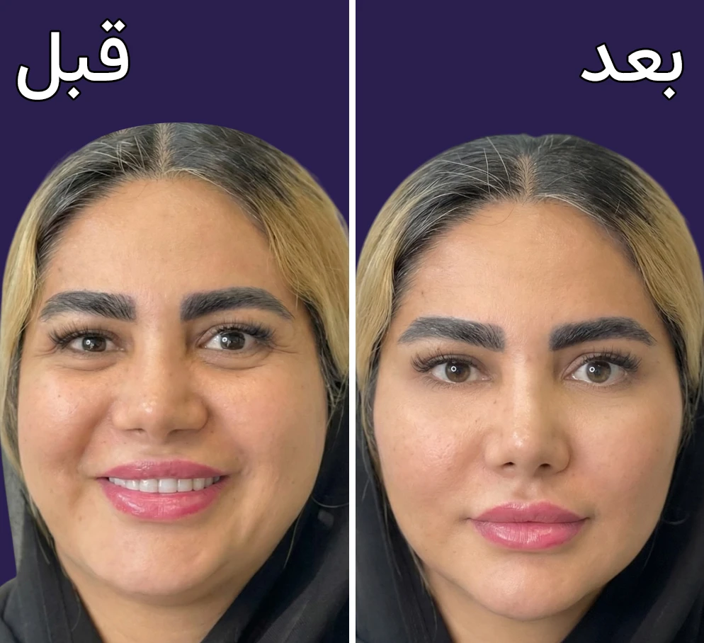 قبل و بعد کانتورینگ صورت