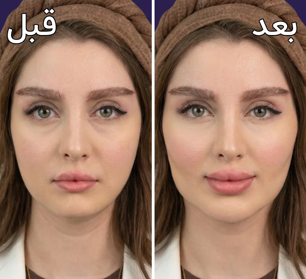 قبل و بعد کانتورینگ صورت