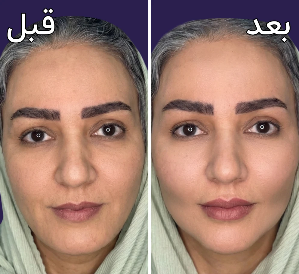 قبل و بعد کانتورینگ صورت