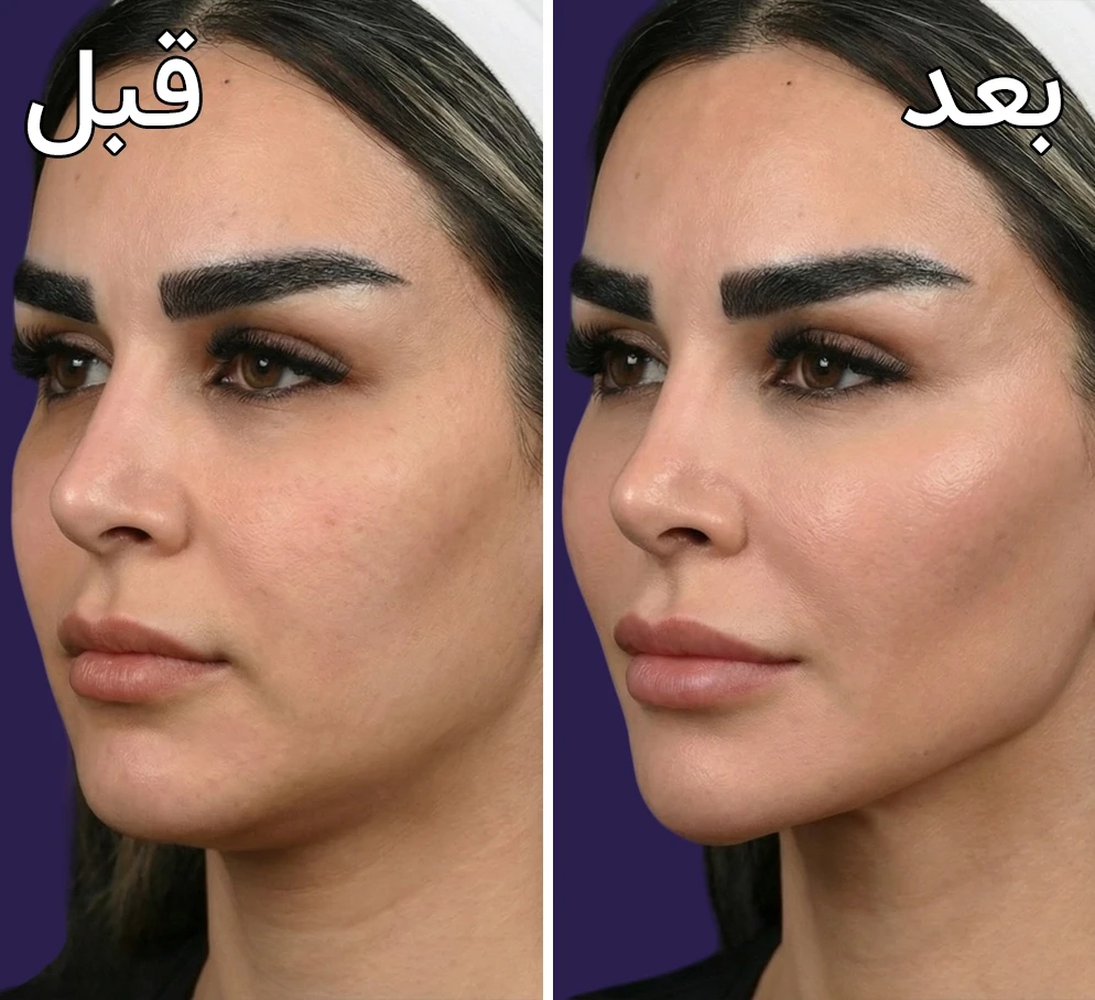قبل و بعد کانتورینگ صورت