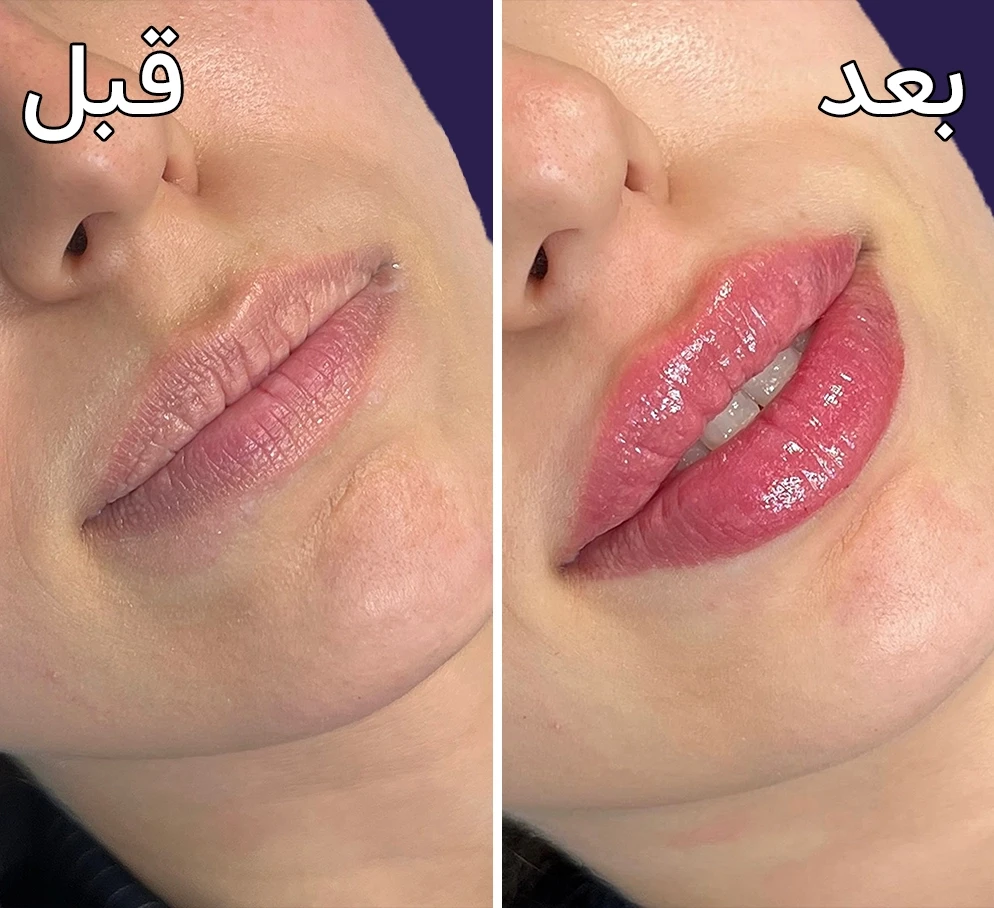 قبل و بعد تزریق فیلرلب