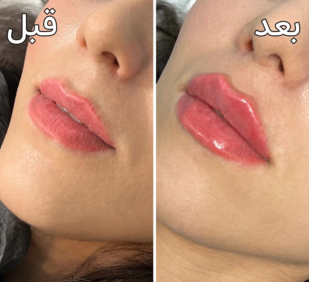 قبل و بعد تزریق فیلرلب