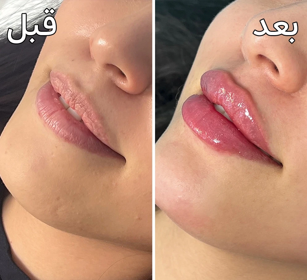 قبل و بعد تزریق فیلرلب