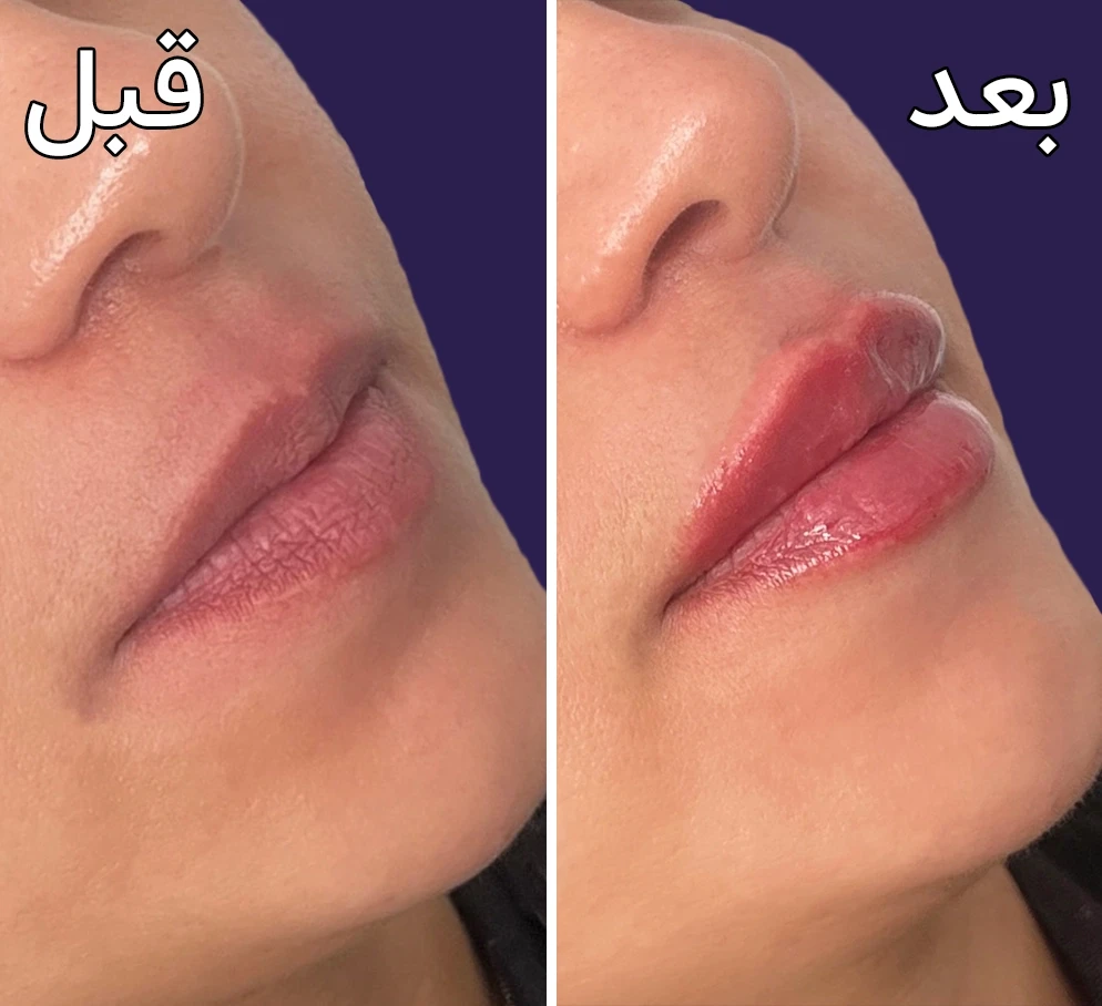 قبل و بعد تزریق فیلرلب