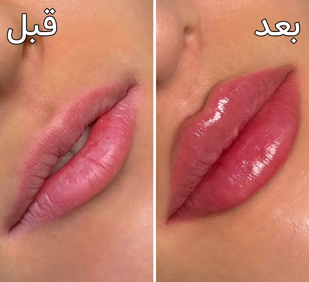 قبل و بعد تزریق فیلرلب