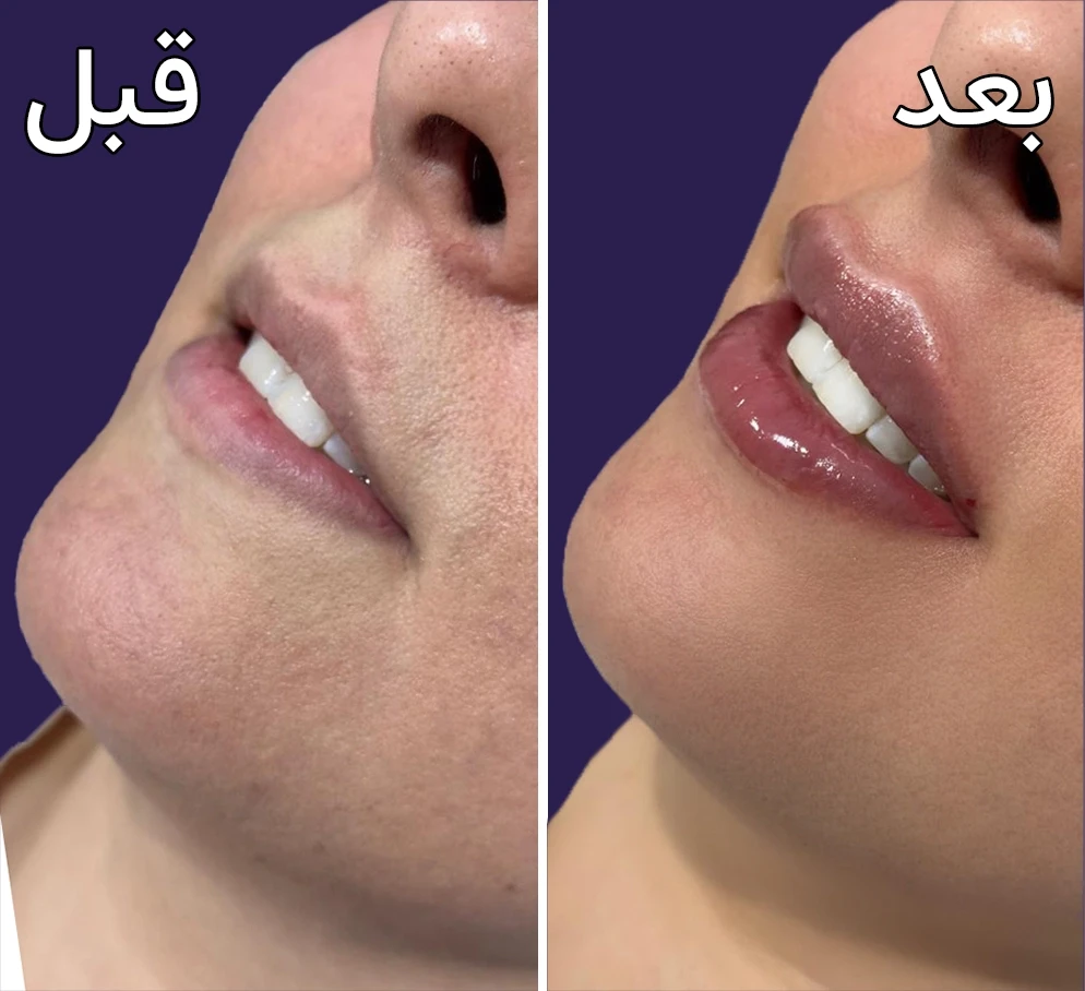 قبل و بعد تزریق فیلرلب